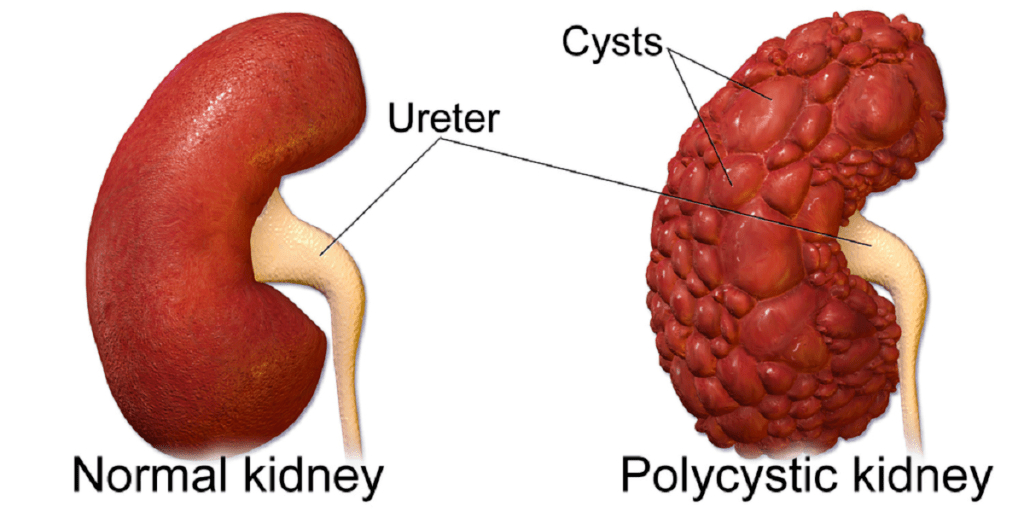 Het leed dat HCM, PKD en/of CIN heet.